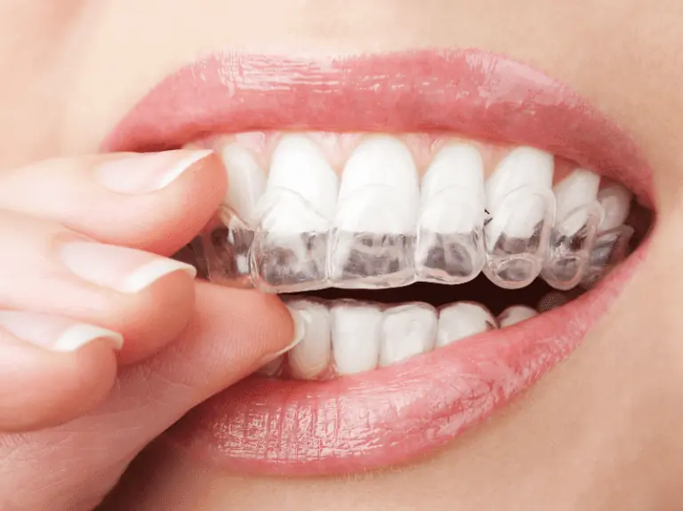 Избелване на зъбите – рискове за здравето на венците и зъбите
