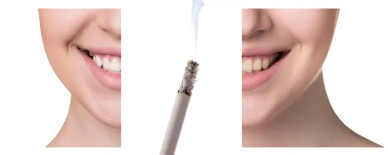 Пушачите са застрашени в много по-голяма степен от загуба на зъби от непушачите!