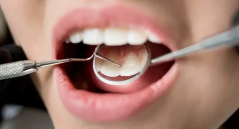 Срещу зъбна плака – ефективни естествени решения