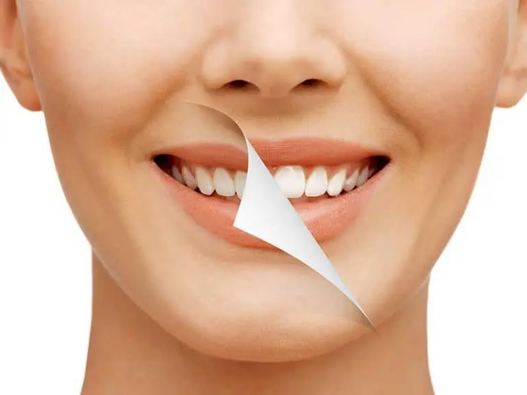 Зъбни налепи – методи за премахването им