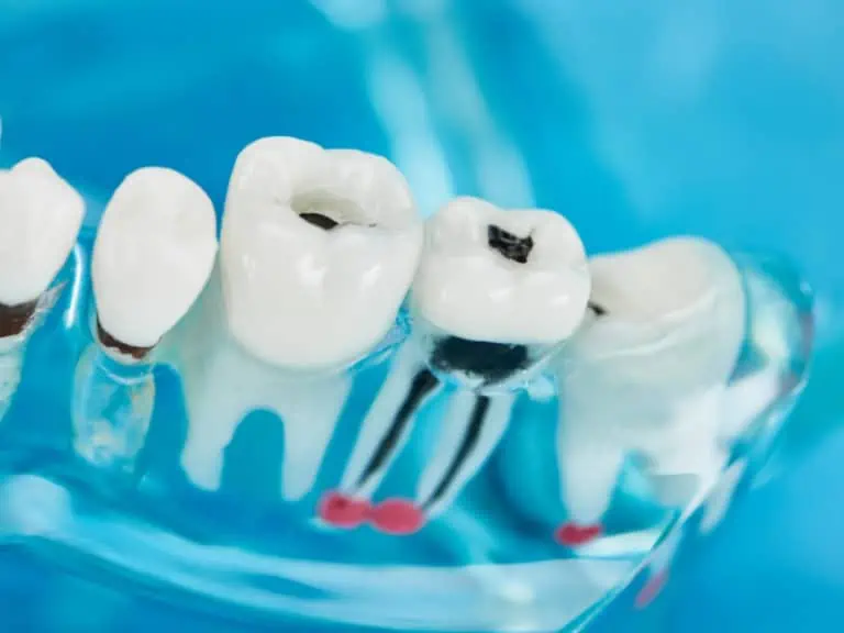 Зъбен кариес – често срещани причини и профилактика