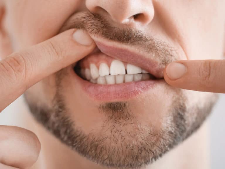 домашно лечение на кървящи венци