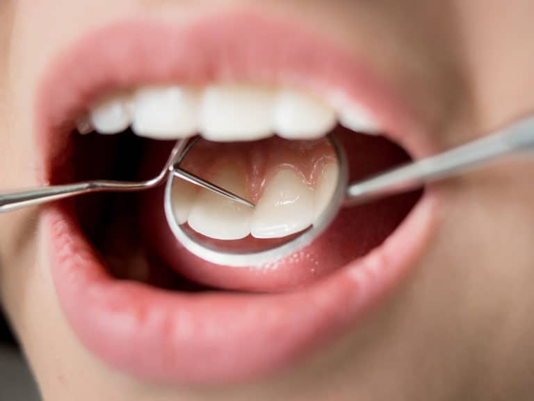 Как да предотвратя образуването на зъбен камък